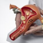 endometriosis